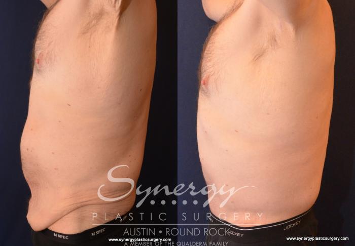 Before & After Post Weight Loss Surgery Case 599 View #5 View in Austin, TX