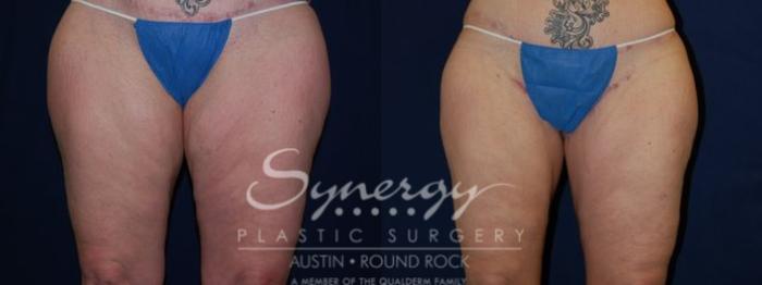 Before & After Post Weight Loss Surgery Case 63 View #1 View in Austin, TX