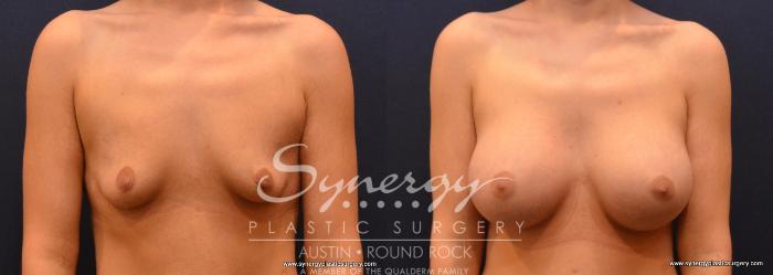 Before & After Post Weight Loss Surgery Case 640 View #1 View in Austin, TX