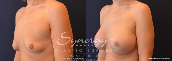 Before & After Post Weight Loss Surgery Case 640 View #2 View in Austin, TX