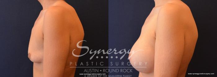 Before & After Post Weight Loss Surgery Case 640 View #3 View in Austin, TX