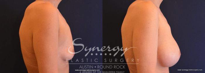 Before & After Post Weight Loss Surgery Case 640 View #4 View in Austin, TX