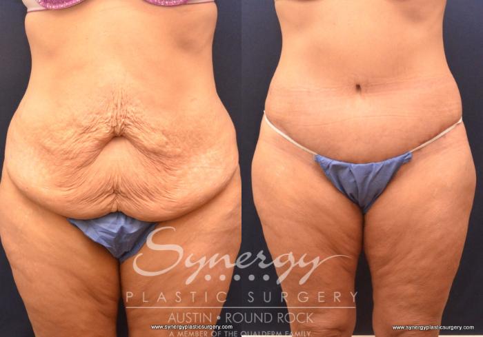 Before & After Post Weight Loss Surgery Case 719 View #1 View in Austin, TX