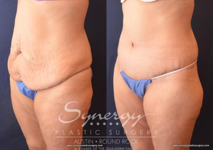 Before & After Post Weight Loss Surgery Case 719 View #2 View in Austin, TX