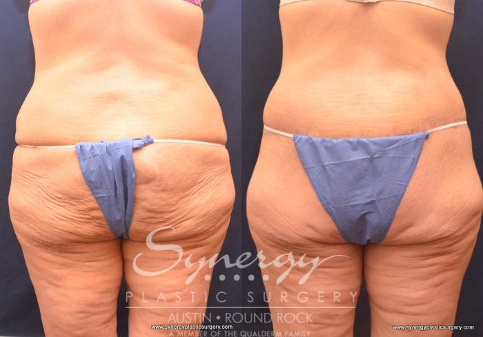 Before & After Post Weight Loss Surgery Case 719 View #3 View in Austin, TX