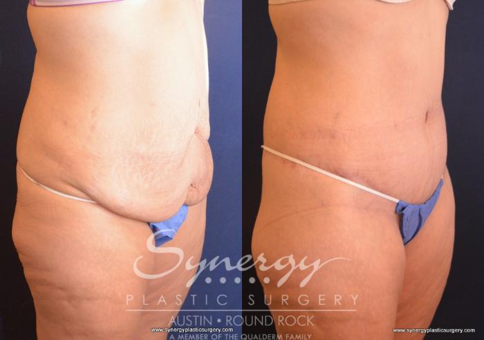 Before & After Post Weight Loss Surgery Case 719 View #4 View in Austin, TX