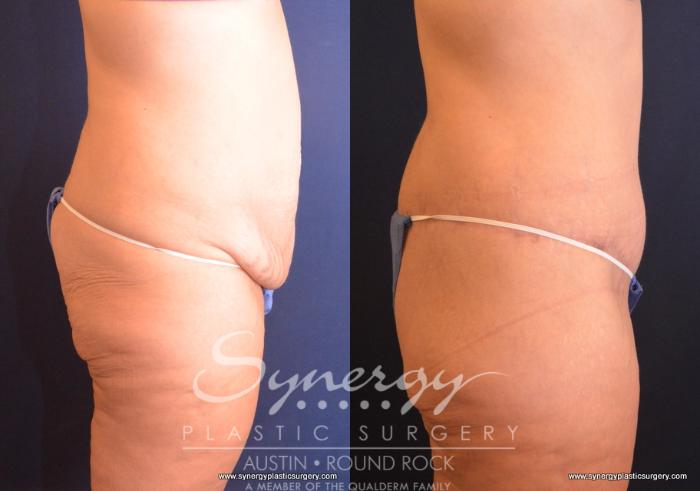 Before & After Post Weight Loss Surgery Case 719 View #5 View in Austin, TX