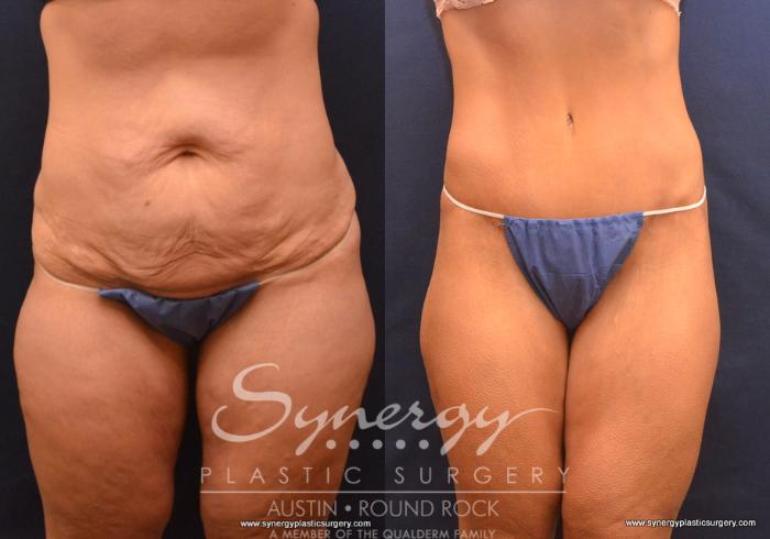 Before & After Post Weight Loss Surgery Case 735 View #1 View in Austin, TX