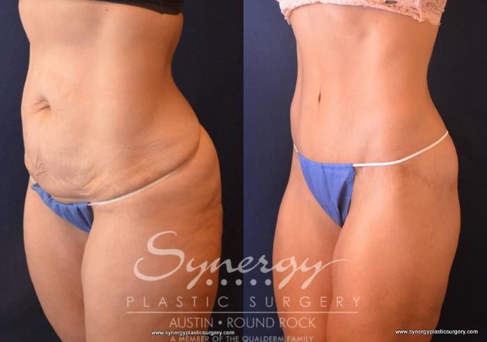 Before & After Post Weight Loss Surgery Case 735 View #2 View in Austin, TX
