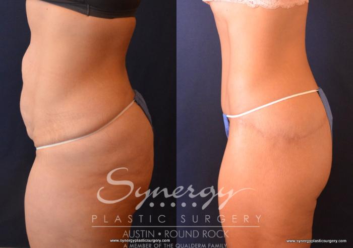 Before & After Post Weight Loss Surgery Case 735 View #3 View in Austin, TX