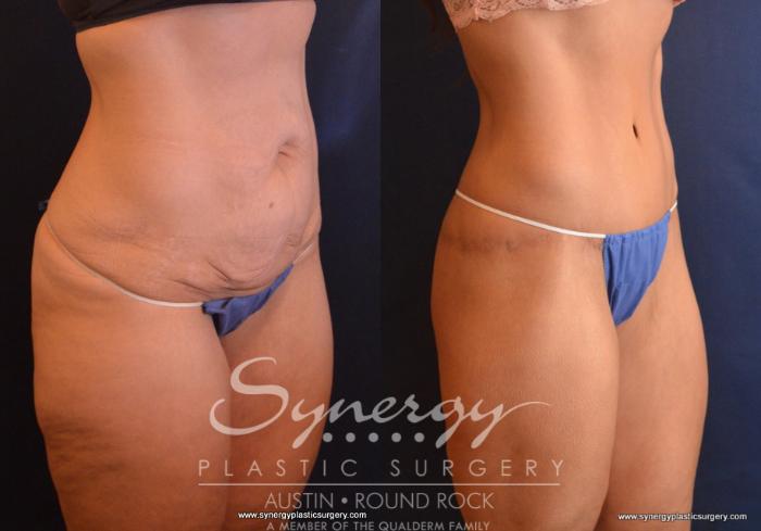 Before & After Post Weight Loss Surgery Case 735 View #4 View in Austin, TX