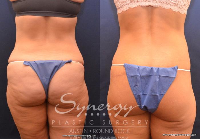Before & After Post Weight Loss Surgery Case 735 View #6 View in Austin, TX