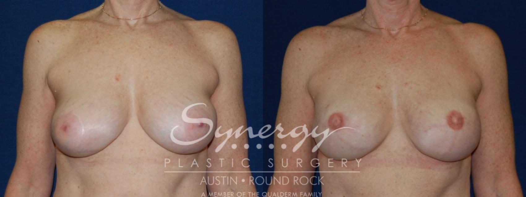 Before & After Reconstruction - Breast Cancer Case 139 View #1 View in Round Rock, TX