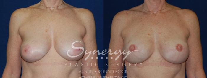 Before & After Reconstruction - Breast Cancer Case 139 View #1 View in Austin, TX