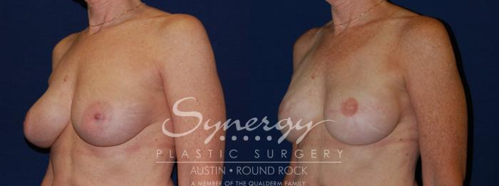 Before & After Reconstruction - Breast Cancer Case 139 View #2 View in Austin, TX
