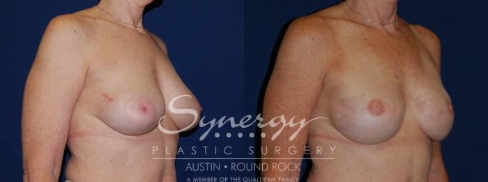 Before & After Reconstruction - Breast Cancer Case 139 View #3 View in Austin, TX