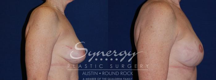Before & After Reconstruction - Breast Cancer Case 139 View #4 View in Austin, TX