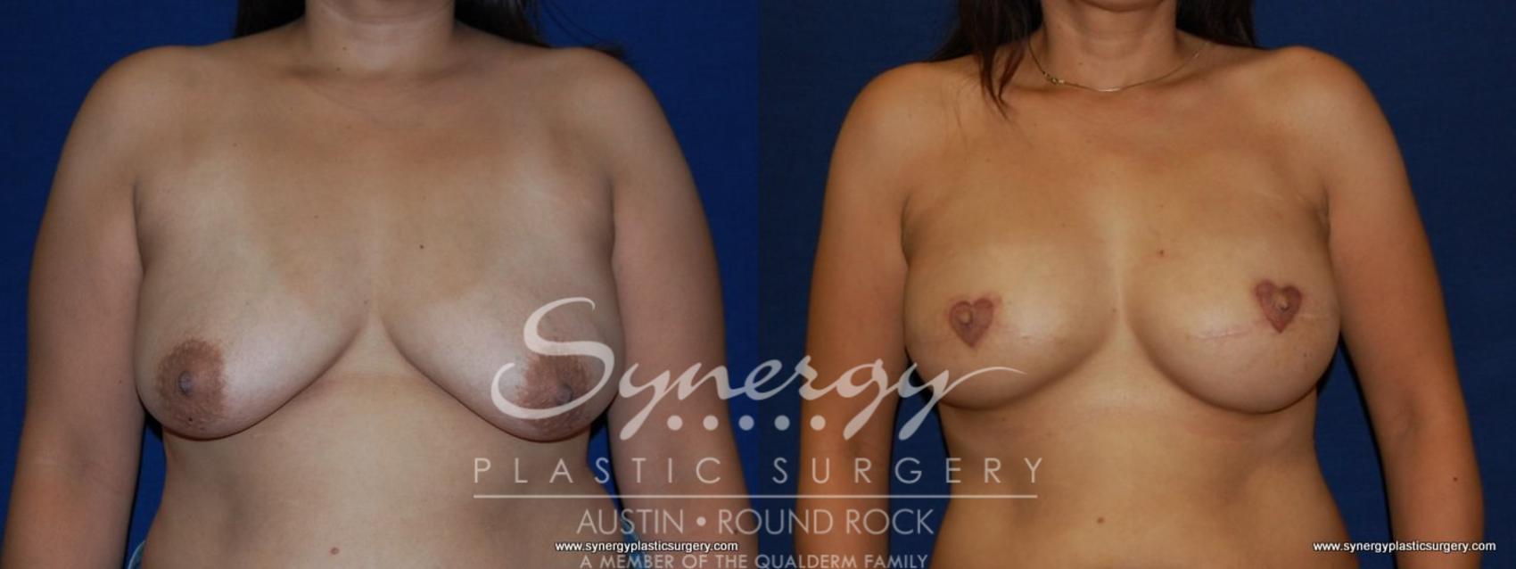 Before & After Reconstruction - Breast Cancer Case 157 View #1 View in Round Rock, TX