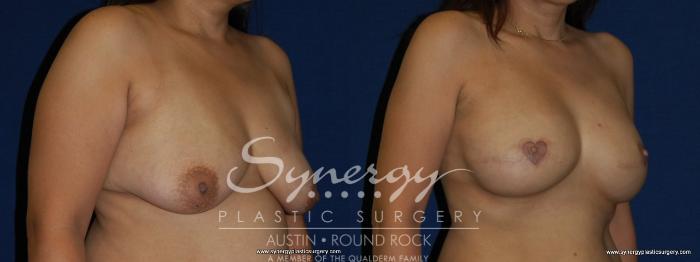 Before & After Reconstruction - Breast Cancer Case 157 View #2 View in Austin, TX