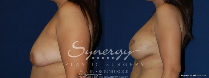 Before & After Reconstruction - Breast Cancer Case 157 View #3 View in Austin, TX