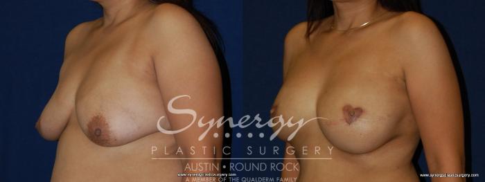 Before & After Reconstruction - Breast Cancer Case 157 View #4 View in Austin, TX