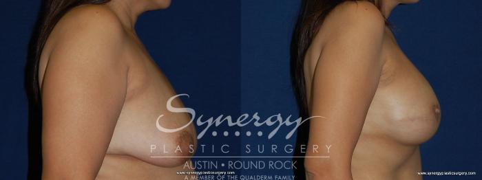 Before & After Reconstruction - Breast Cancer Case 157 View #5 View in Austin, TX