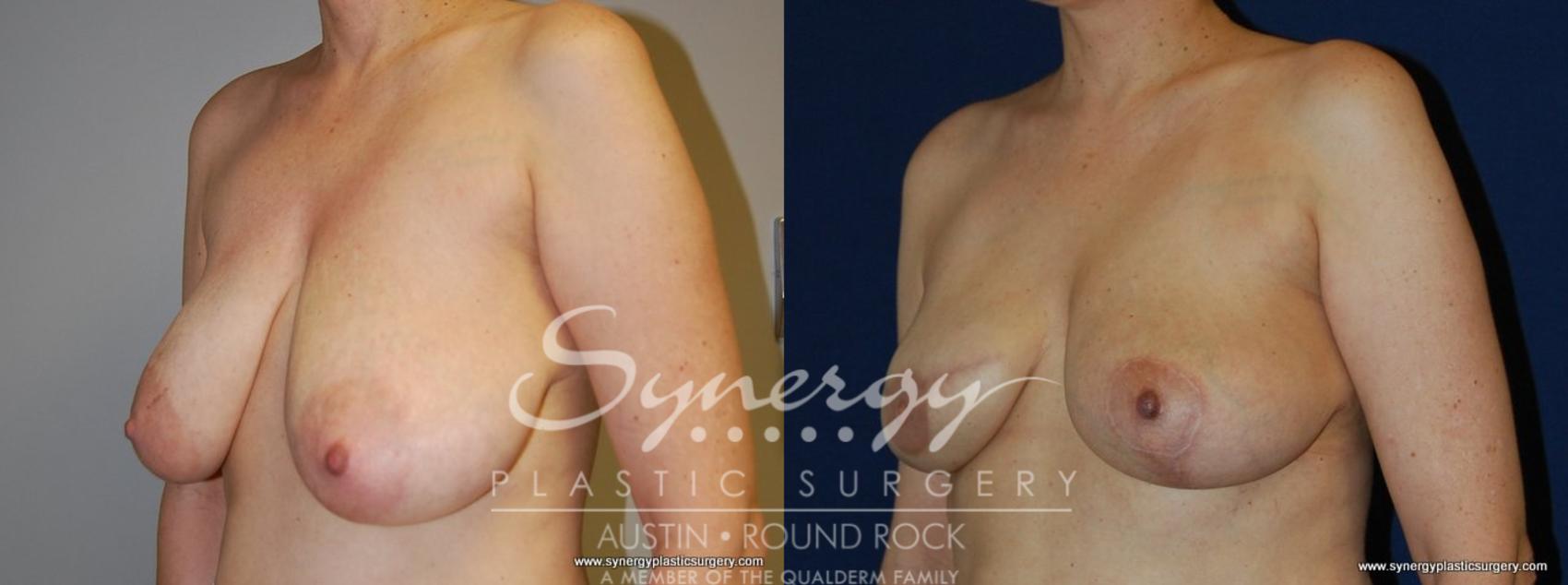 Before & After Reconstruction - Breast Cancer Case 158 View #1 View in Austin, TX