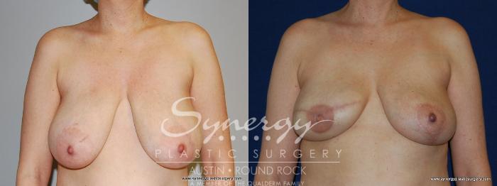 Before & After Reconstruction - Breast Cancer Case 158 View #2 View in Austin, TX