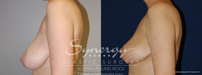 Before & After Reconstruction - Breast Cancer Case 158 View #3 View in Austin, TX