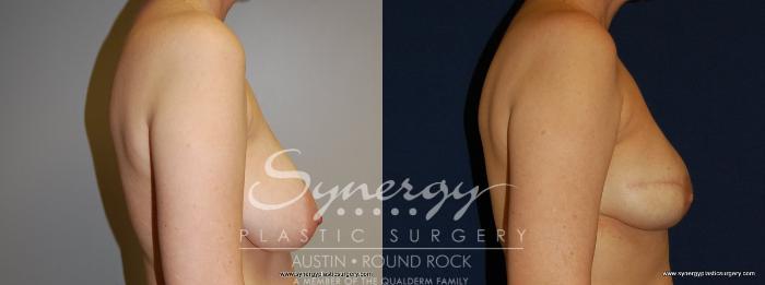 Before & After Reconstruction - Breast Cancer Case 158 View #4 View in Austin, TX
