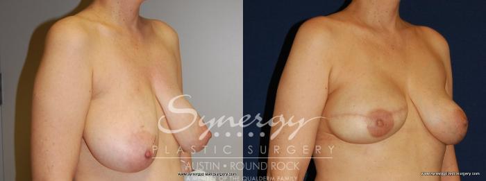 Before & After Reconstruction - Breast Cancer Case 158 View #5 View in Austin, TX