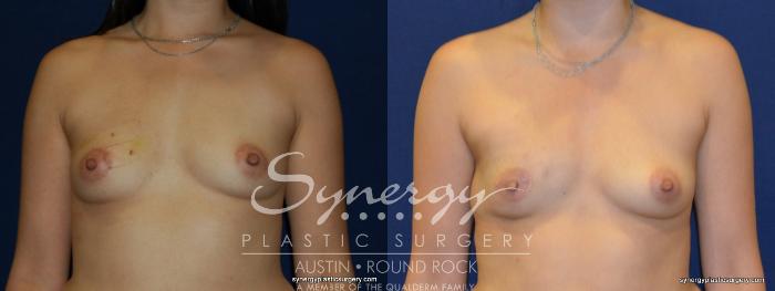 Before & After Reconstruction - Breast Cancer Case 236 View #2 View in Austin, TX