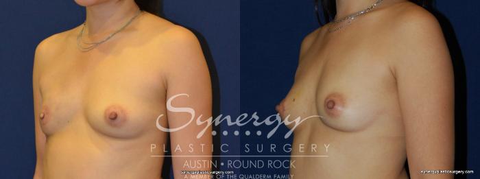 Before & After Reconstruction - Breast Cancer Case 236 View #4 View in Austin, TX