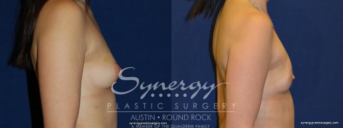 Before & After Reconstruction - Breast Cancer Case 236 View #5 View in Austin, TX