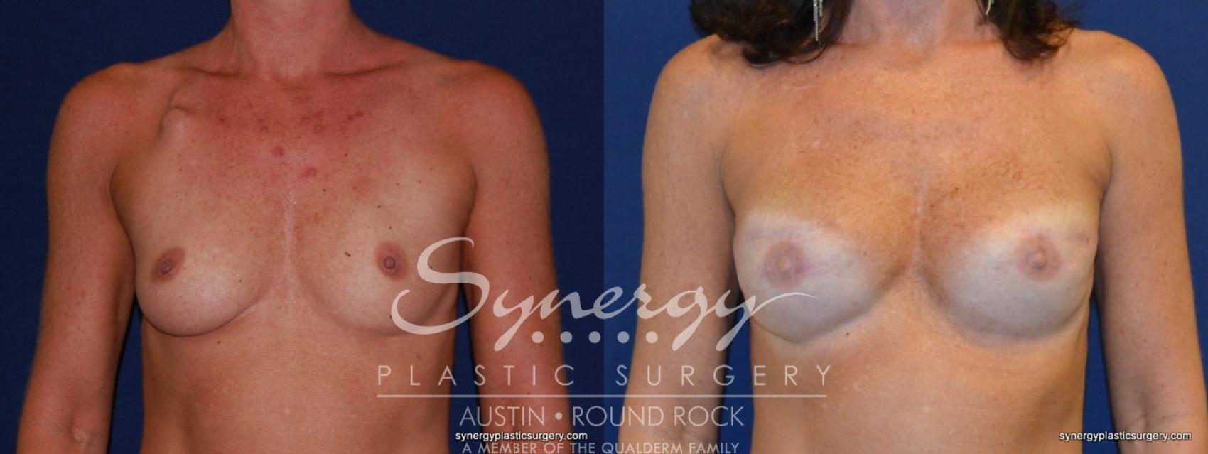 Before & After Reconstruction - Breast Cancer Case 237 View #1 View in Round Rock, TX