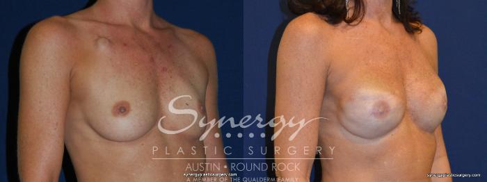 Before & After Reconstruction - Breast Cancer Case 237 View #2 View in Austin, TX
