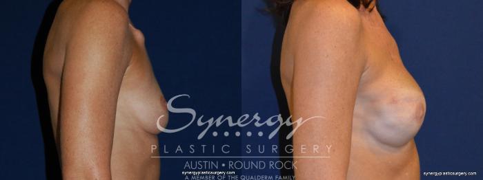 Before & After Reconstruction - Breast Cancer Case 237 View #3 View in Austin, TX