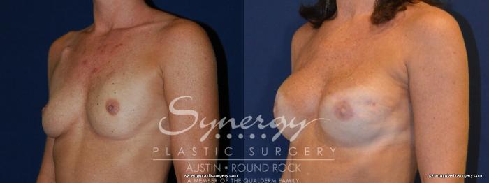 Before & After Reconstruction - Breast Cancer Case 237 View #4 View in Austin, TX