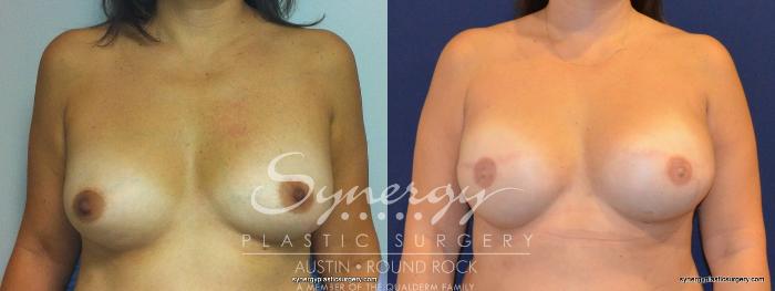 Before & After Reconstruction - Breast Cancer Case 238 View #2 View in Austin, TX