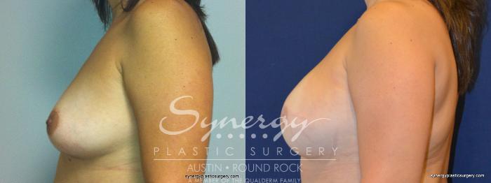 Before & After Reconstruction - Breast Cancer Case 238 View #3 View in Austin, TX
