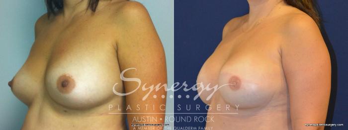 Before & After Reconstruction - Breast Cancer Case 238 View #4 View in Austin, TX