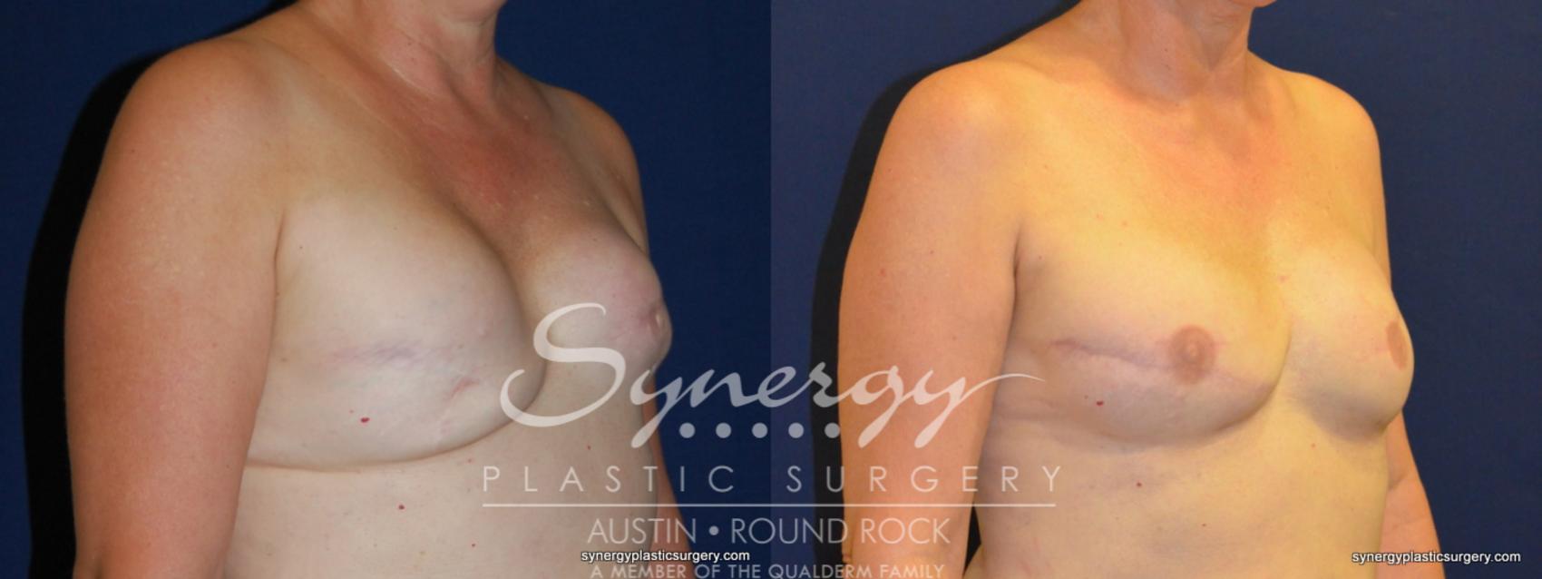 Before & After Reconstruction - Breast Cancer Case 239 View #1 View in Austin, TX