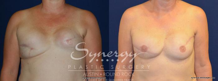 Before & After Reconstruction - Breast Cancer Case 239 View #2 View in Austin, TX