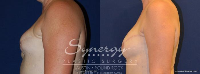 Before & After Reconstruction - Breast Cancer Case 239 View #3 View in Austin, TX