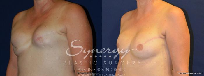 Before & After Reconstruction - Breast Cancer Case 239 View #4 View in Austin, TX