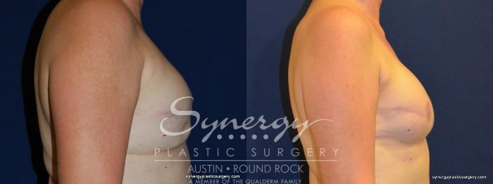 Before & After Reconstruction - Breast Cancer Case 239 View #5 View in Austin, TX
