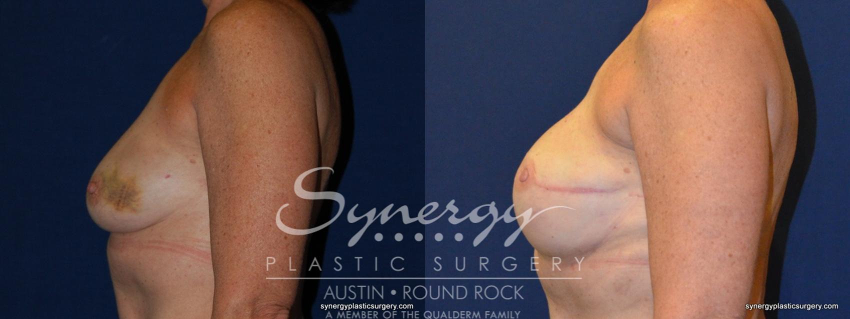 Before & After Reconstruction - Breast Cancer Case 240 View #1 View in Round Rock, TX