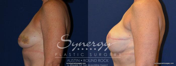 Before & After Reconstruction - Breast Cancer Case 240 View #1 View in Austin, TX
