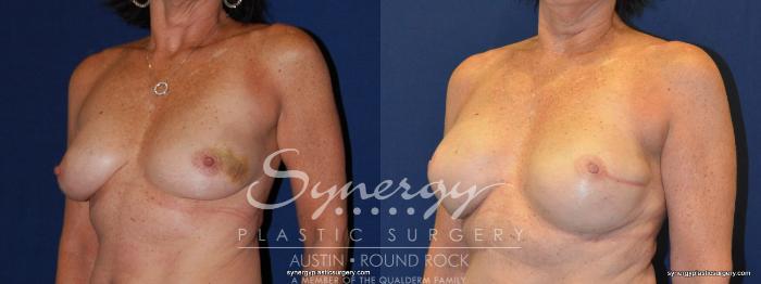 Before & After Reconstruction - Breast Cancer Case 240 View #2 View in Austin, TX