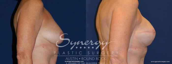 Before & After Reconstruction - Breast Cancer Case 240 View #3 View in Austin, TX